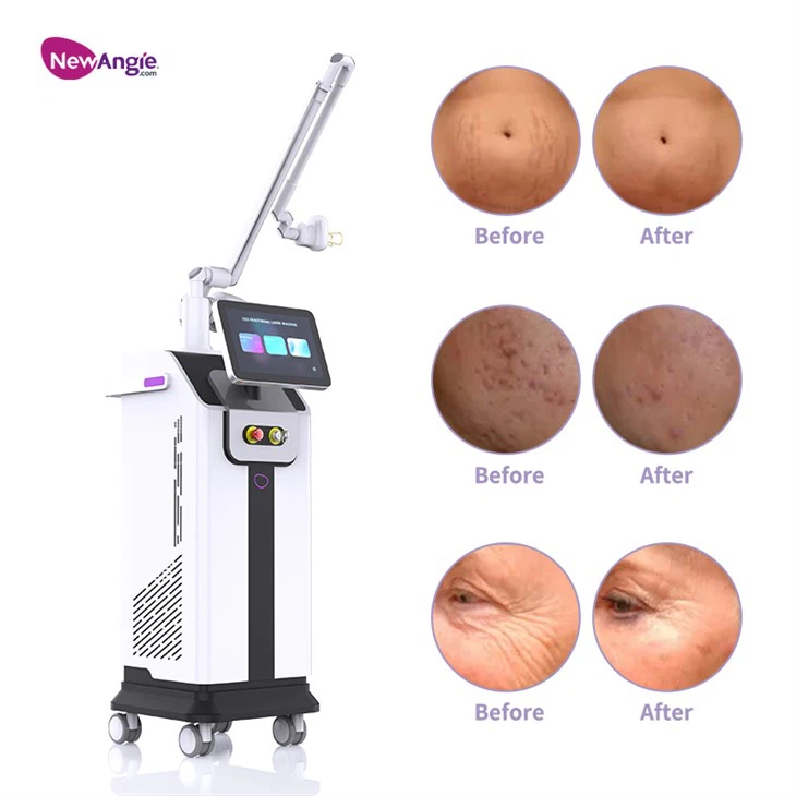 Vaginal Co2 Laser Machine